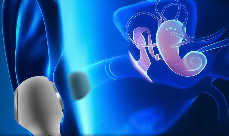 migrainestopper adv 6 01